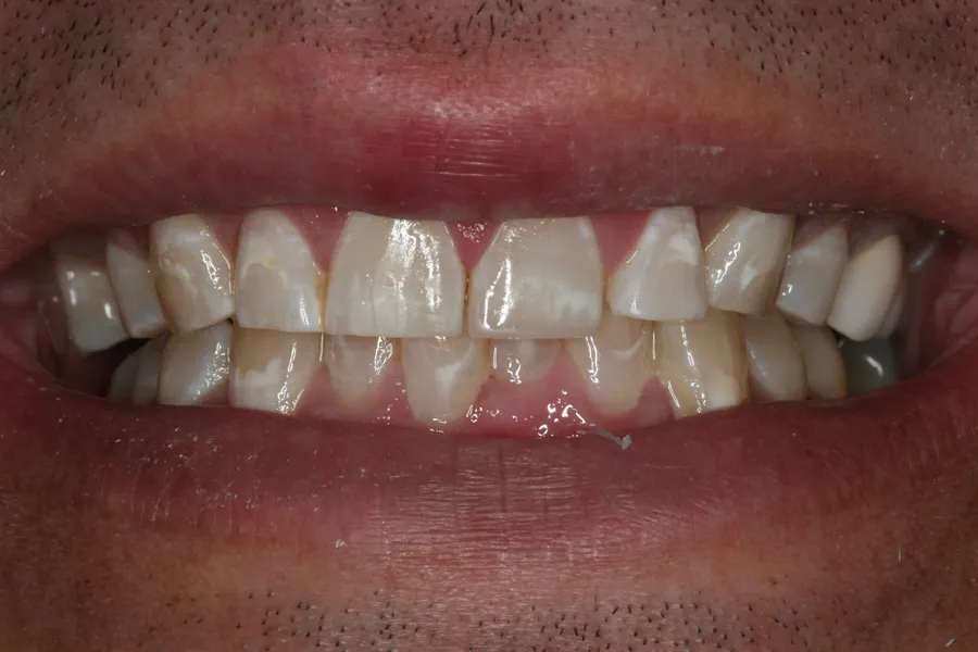 Fractured Teeth, Composite Bonding: Bobby — after