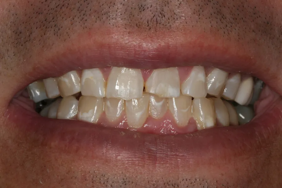Fractured Teeth, Composite Bonding: Bobby — before
