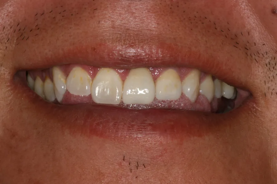 Two Fractured Teeth Restored: Brad — after