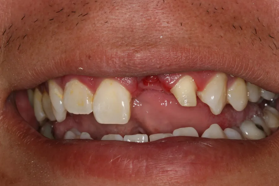 Two Fractured Teeth Restored: Brad — before