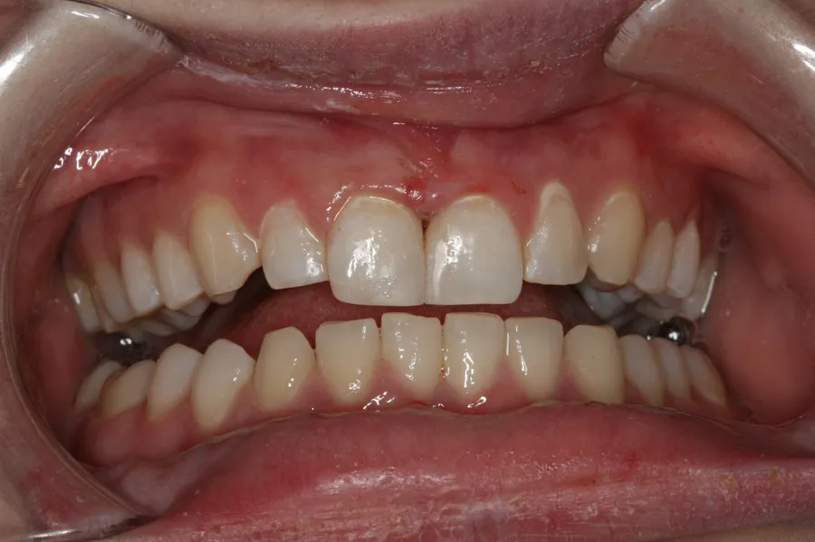 Fractured Tooth, Composite Bonding: Breanna — after