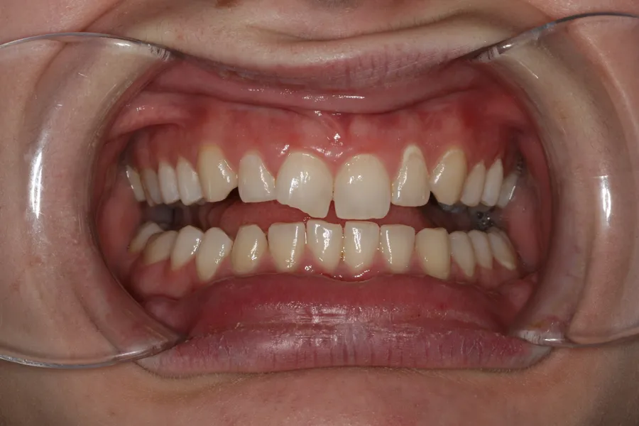 Fractured Tooth, Composite Bonding: Breanna — before