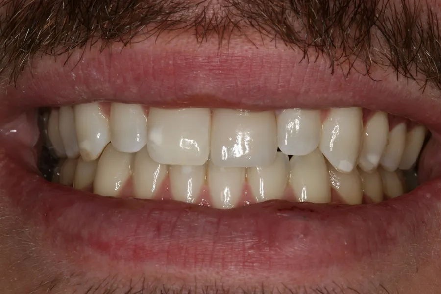 Fractured Tooth, Porcelain Veneer: Caz — after