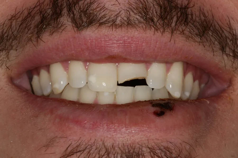 Fractured Tooth, Porcelain Veneer: Caz — before