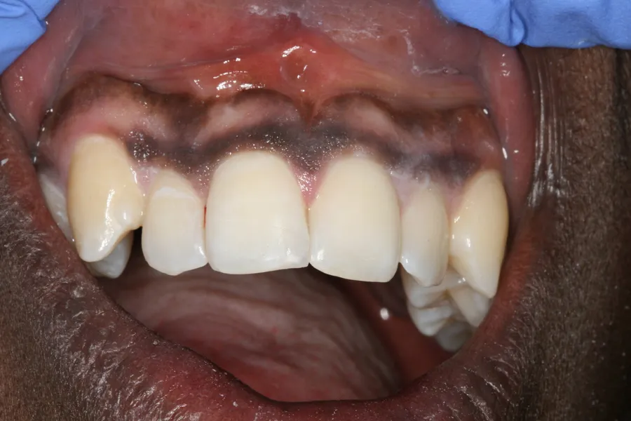Fractured Tooth, Composite Bonding: Daron — after