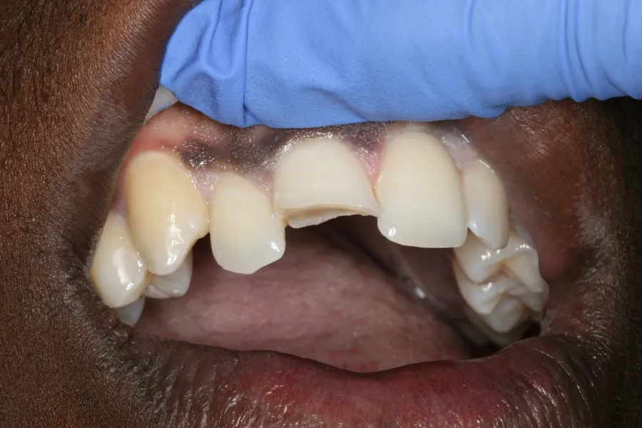 Fractured Tooth, Composite Bonding: Daron — before