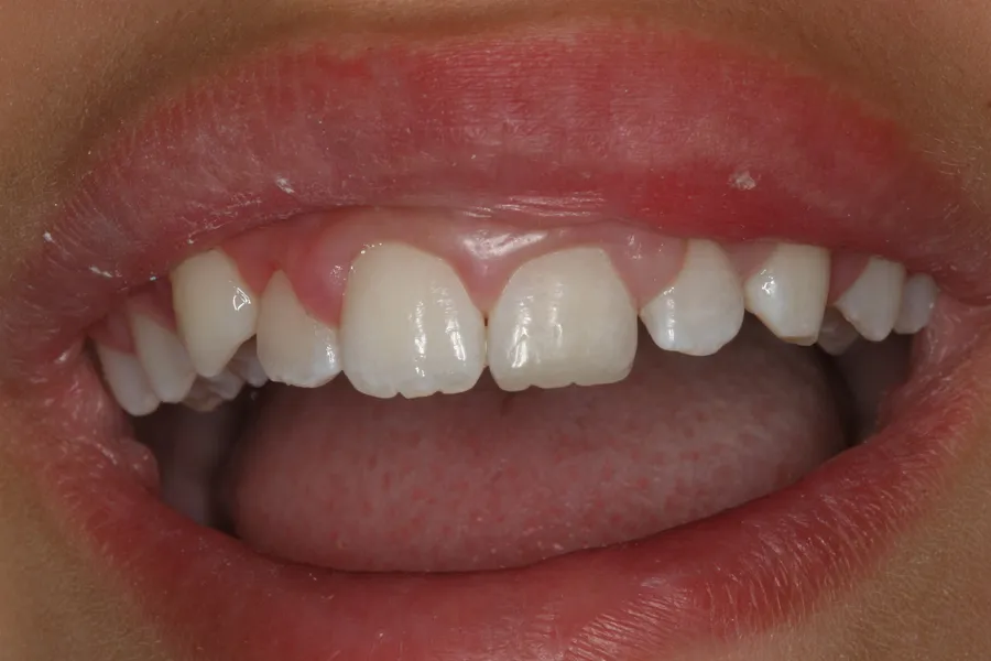 Fractured Tooth, Composite Bonding: Isabelle — after