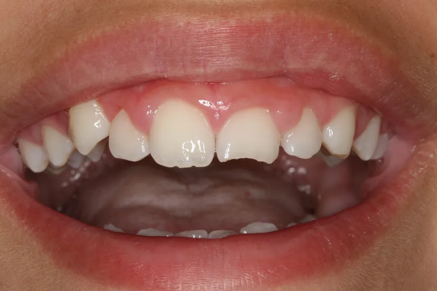 Fractured Tooth, Composite Bonding: Isabelle — before