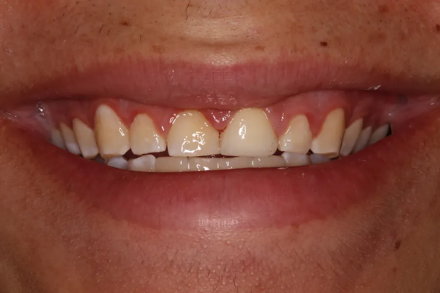 Fractured Tooth, Root Canal, Post & Crown: Issac — after