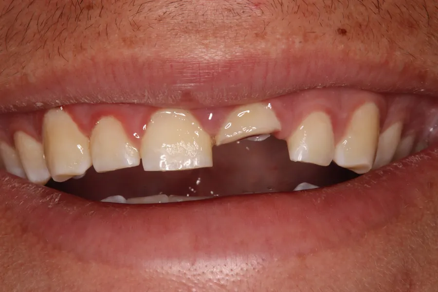 Fractured Tooth, Root Canal, Post & Crown: Issac — before