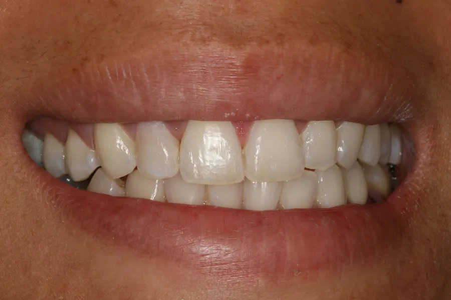 Knocked-Out Tooth, Splinted & Bonded: Jessica — after