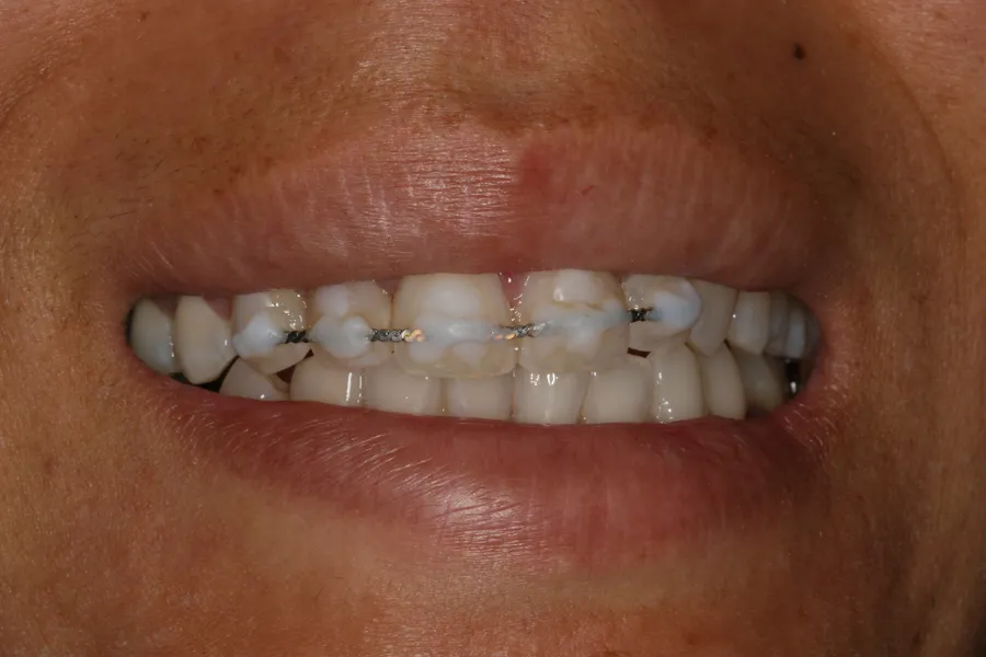 Knocked-Out Tooth, Splinted & Bonded: Jessica — before
