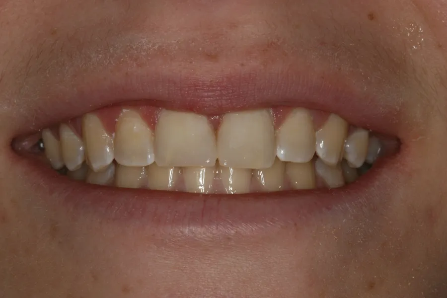 Fractured Tooth, Composite Bonding: Maggie — after