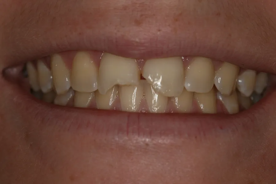 Fractured Tooth, Composite Bonding: Maggie — before