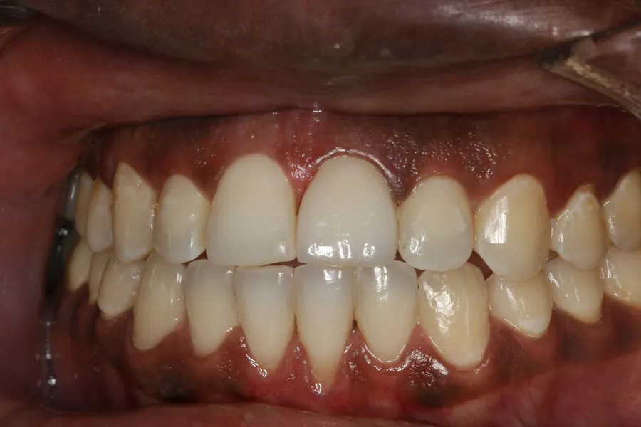 Fractured Tooth, Porcelain Veneer: Nasir — after