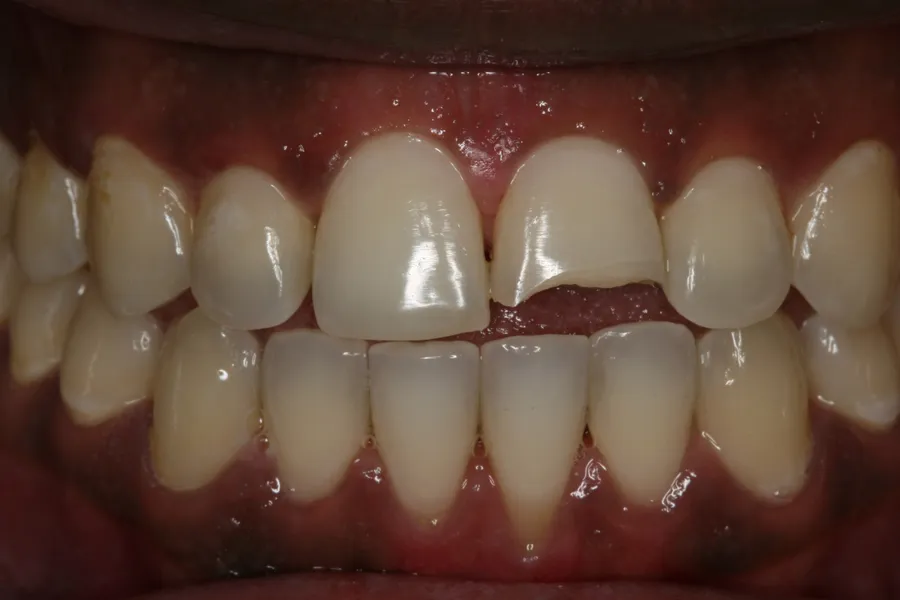 Fractured Tooth, Porcelain Veneer: Nasir — before