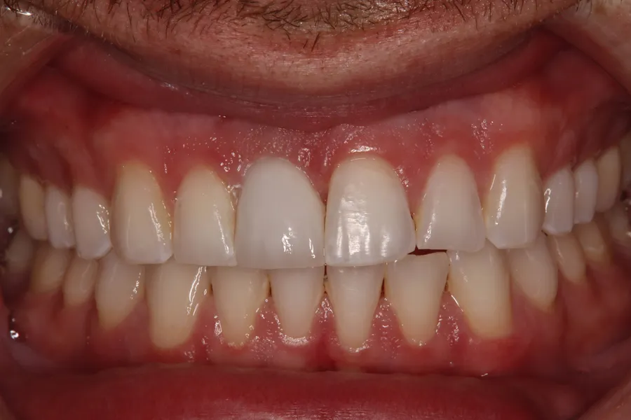 Fractured Root → Same-Day Implant: Nick — after