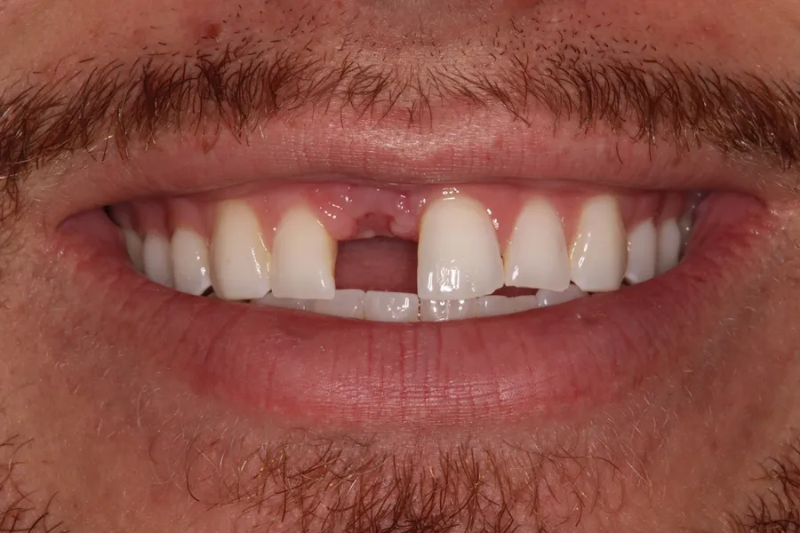 Fractured Root → Same-Day Implant: Nick — before