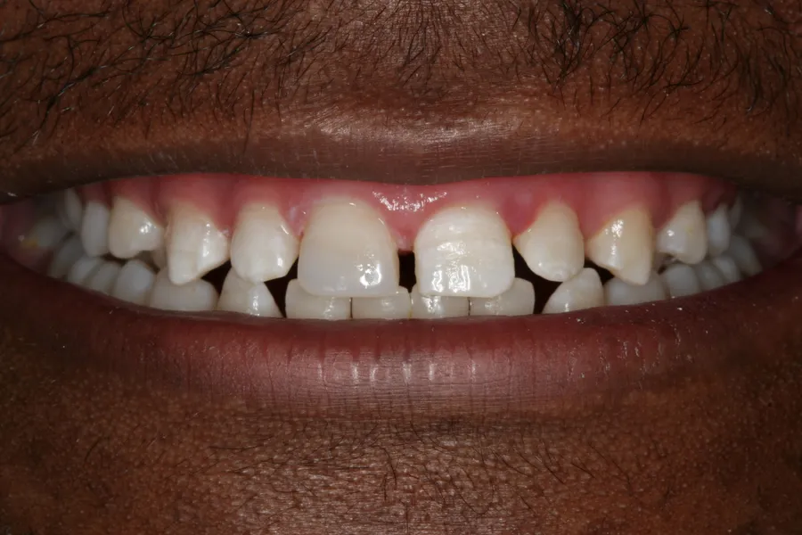 Fractured Front Tooth, Same-Day Bonding: Tabo — after