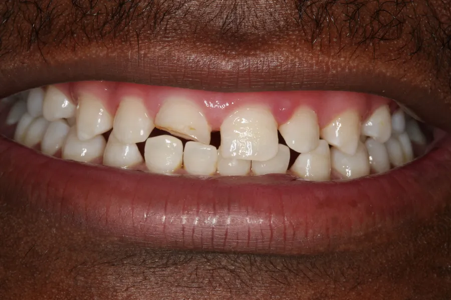 Fractured Front Tooth, Same-Day Bonding: Tabo — before