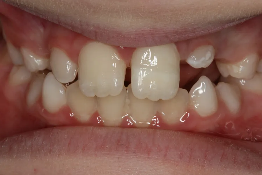 Fractured Tooth Rebonded: Zach — after