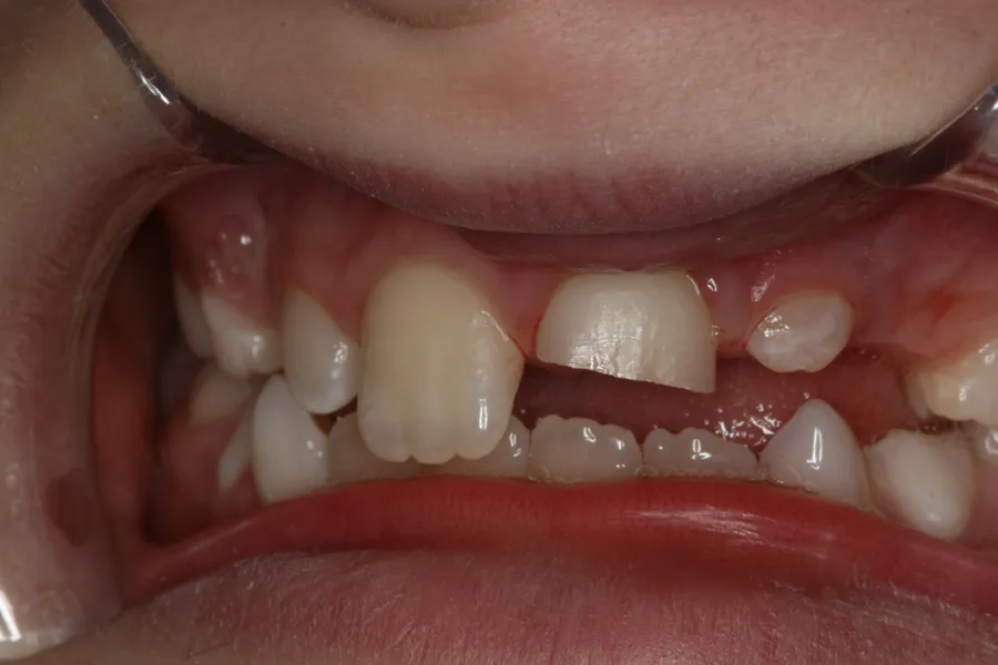 Fractured Tooth Rebonded: Zach — before